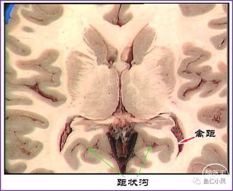 禽距裂